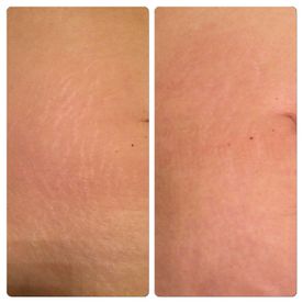 Bacuhdecke nach Microneedling