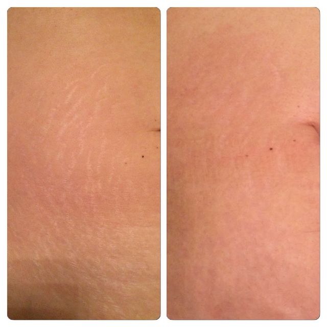 Bacuhdecke nach Microneedling