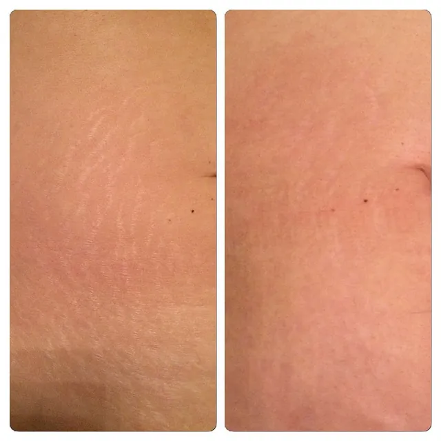 Bacuhdecke nach Microneedling