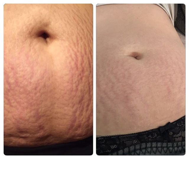 Bauchdecke nach Microneedling