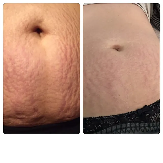 Bauchdecke nach Microneedling