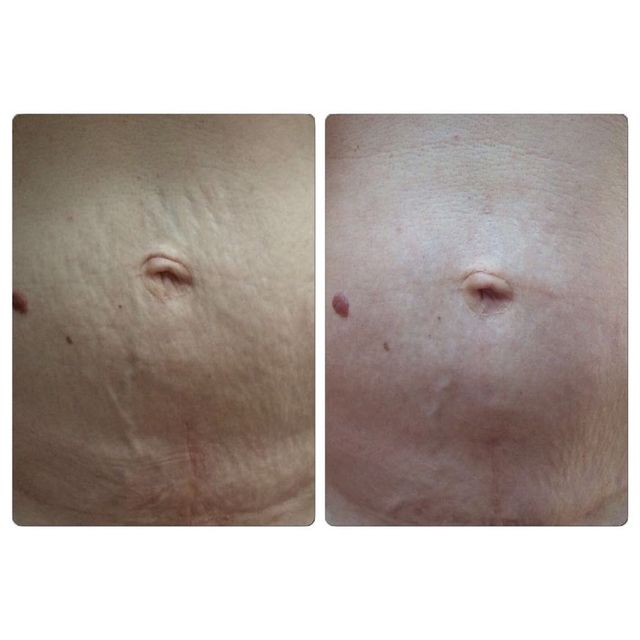 Bacuhdecke nach Microneedling