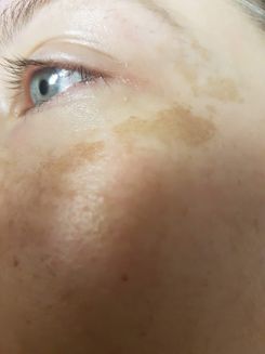 Pigmentflecken vor Behandlung