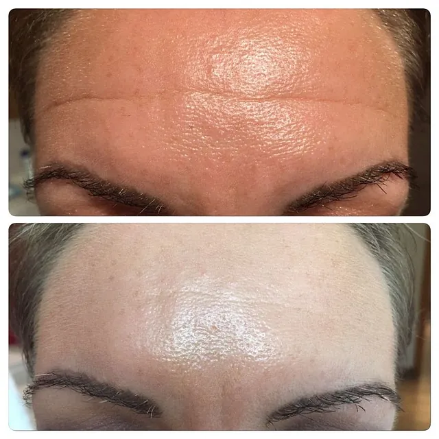 Stirn nach Microneedling