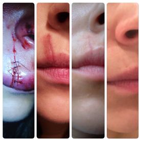 Narbenbehandlung
