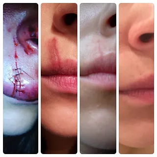Lippe nach Hundebiss